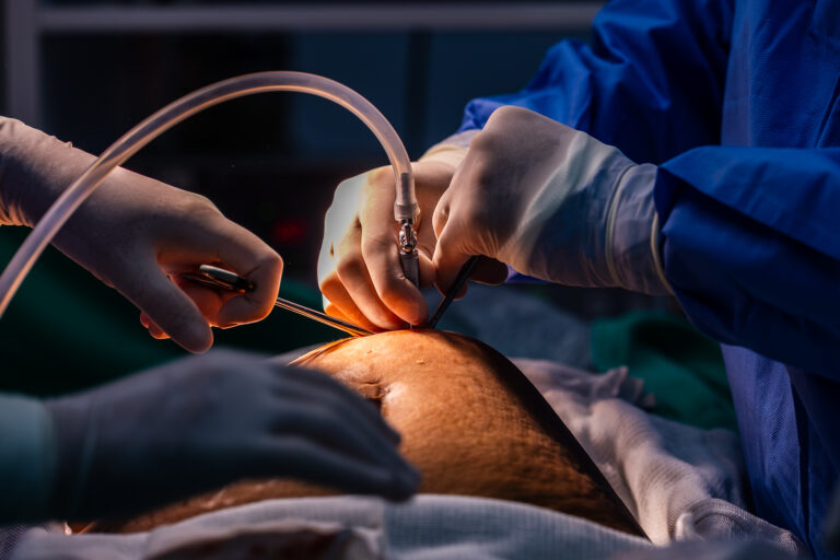 Santa Catarina amplia cirurgias bariátricas pelo SUS com novo serviço em Joinville